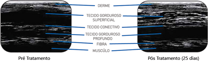 Ecografia Criofrequência