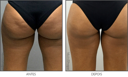 MultiShape Antes e Depois