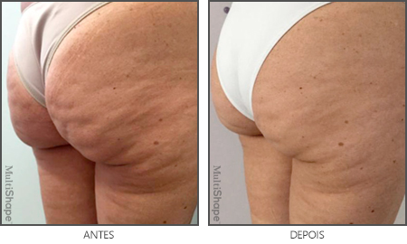 MultiShape Antes e Depois