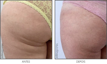 MultiShape Antes e Depois